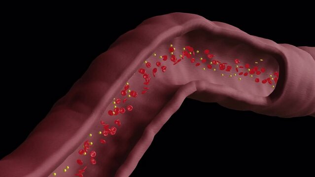 Closeup Cholesterol Buildup in Blood Vessel (cross-section) - AlphaBG