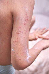 food allergy. a boy with red spots. The child has itching, with an allergic rash..