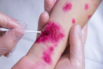 The skin rash in a child is treated with a cotton swab. Chickenpox virus. Skin rash and blisters on the body