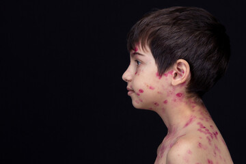 Close-up of cute little children. Chickenpox virus or vesicular rash on a child's body
