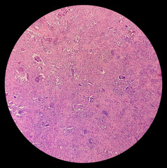 Finger(biopsy): Photomicrograph of giant cell tumor, microscopic show neoplasm of numerous...