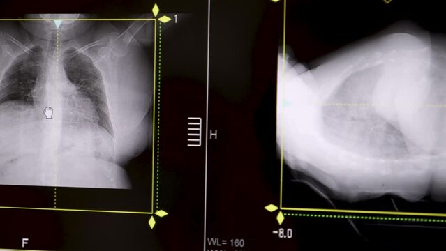 advanced x-ray chest full body in clinic hospital for diagnosis ill disease 