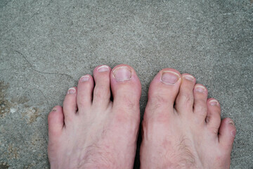 Men's pedicure at home. Cut toenails. Toenails close-up. Untrimmed nails, untidy manicure.