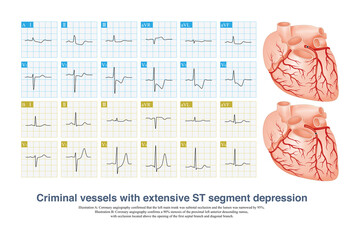 In case of acute coronary syndrome, if the ECG shows extensive ST segment depression, the culprit vessel may be the left main coronary artery or a single coronary artery.