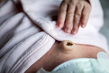 Newborn hand and navel with umbilical cord just fallen off, umbilical hernia in infants - obrazy, fototapety, plakaty