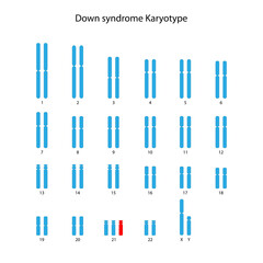 Down syndrome (trisomy 21) human karyotype	