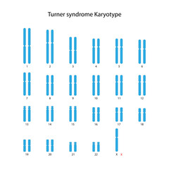 Turner syndrome (X0) human karyotype	