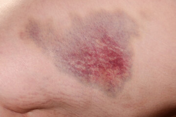 a large bruise on a person's leg. haematoma
