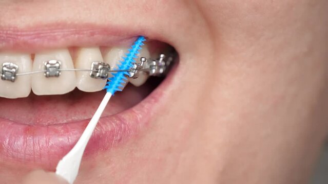 A woman uses a dental brush to clean the braces on her teeth. Braces on the teeth. The concept of bite correction, treatment and orthodontics.