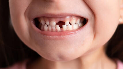 Close-up A cute funny girl without a baby tooth. A toothless smile. A milk tooth fell out. Selective focus