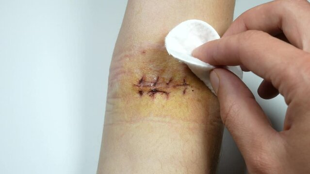 Disinfection of fresh scar on the hand after the surgery. Medical treatment disease photo.