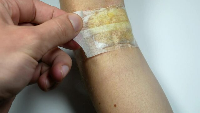 New Scar on the hand after the surgery. Medical treatment disease video.
