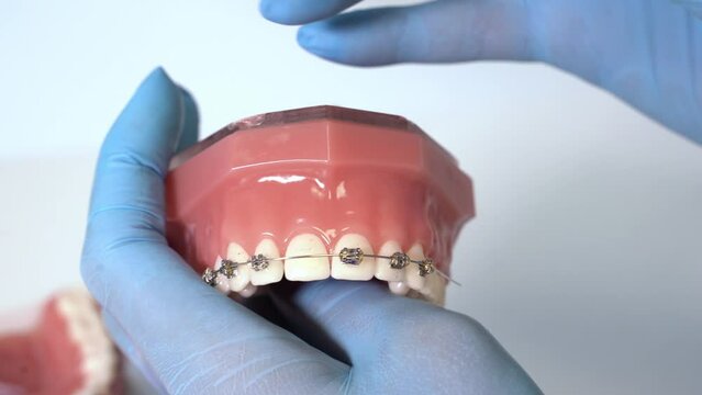 Close up dentist orthodontist holds model of human jaws with braces. Explain to the patient process installing and usage, hygiene braces fix the smile bite occlusion teeth