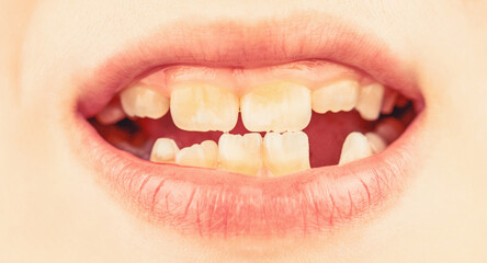 Child smile and show her crowding tooth. Close up of unhealthy baby teeths. Kid patient open mouth...