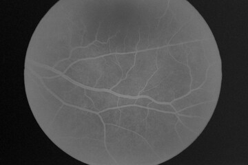 Fluorescein angiography of eye disease in the foreground  - obrazy, fototapety, plakaty