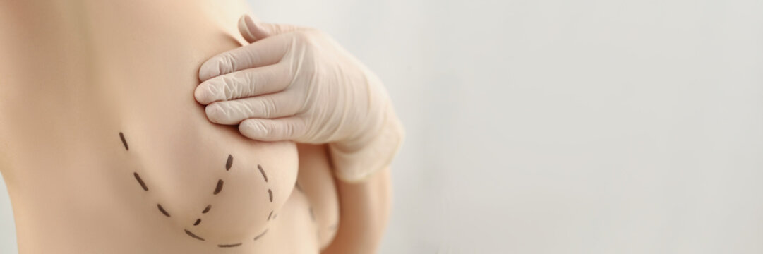Lady client with marking on boob for future cosmetic surgery operation
