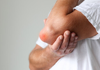 Man swelling erythematous lump pain elbow from Olecranon bursitis, student elbow medical condition....