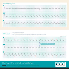 If atrioventricular dissociation and ventricular fusion wave can be found in wide QRS wave tachycardia, the diagnosis of ventricular tachycardia is highly supported.