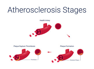 Atherosclerosis diseases stage anatomy diagram vector illustration