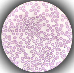 Target cells with abnormal red blood cells from anemia patient, analyze by microscope.