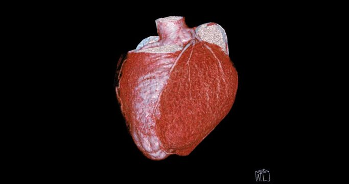 CTA Coronary artery 3D rendering image s detect coronary artery disease from CT Scanner.