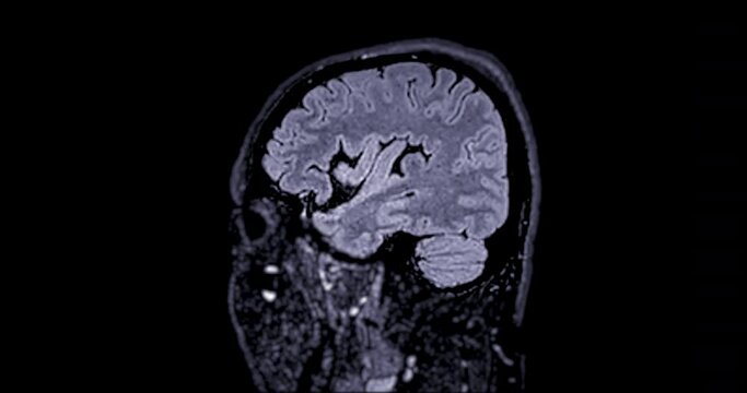 MRI Brain can help doctors look for conditions such as bleeding, swelling, tumors, infections, inflammation, damage from an injury or a stroke diseases.