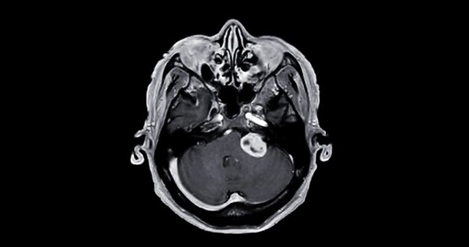 MRI Brain can help doctors look for conditions such as bleeding, swelling, tumors, infections, inflammation, damage from an injury or a stroke diseases.