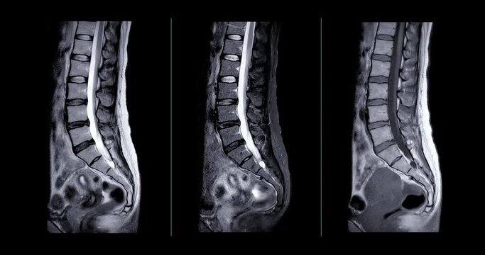 MRI L-S spine or lumbar spine for diagnosis spinal cord compression.