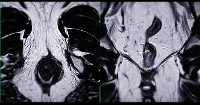 MRI prostate gland for diagnosis  prostate cancer cell and evaluate the extent of prostate cancer  in aged men.
