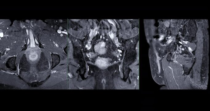 MRI Prostate Gland For Diagnosis  Prostate Cancer Cell And Evaluate The Extent Of Prostate Cancer  In Aged Men.