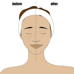 The face of a girl with a bandage on her hair with freckles before and after bleaching freckles and age spots