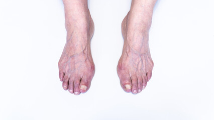 Bunion or hallux valgus on senior woman foot. Deformity of the joint connecting the big toe to the...