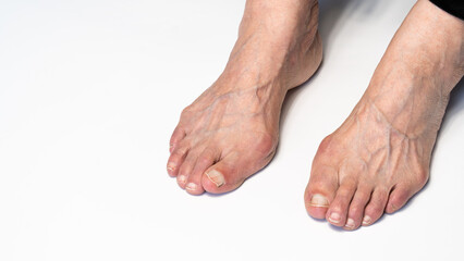 Bunion or hallux valgus on senior woman foot. Deformity of the joint connecting the big toe to the foot. Skeletal disorder on old woman body