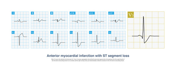 In AMI, sometimes due to ion channel defects, collateral circulation protection, etc., ST segment elevation can be lost, which is easy to be misdiagnosed as NSTMI.