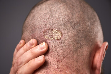 Man with dry flaky skin on his head with psoriasis and nail fungus on hands. Autoimmune genetic disease. © leravalera89