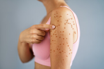 Woman Body Skin With Red Allergy Eruption