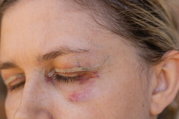 Obraz premium Double Eyelid Surgery, Eyes Surgery Recover Period, immediately after plastic surgery. Eyes After Eyelid Surgery