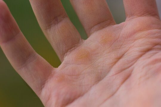 Calluses, skin injury on the hand close-up