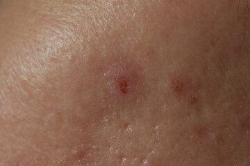 Extreme close-up of texture of problematic human skin with large-looking open pores and acne scars