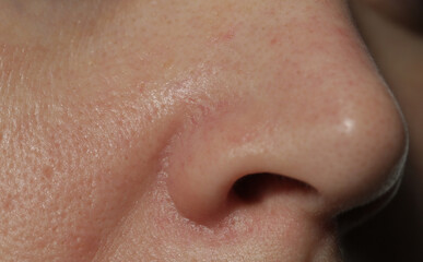 Extreme close-up of texture of problematic human skin with large-looking open pores, acne scars  and nasolabial fold