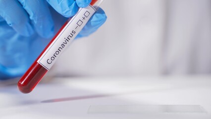 Blood analysis. A doctor drips blood onto a microscope slide from a test tube labeled 2019-nCoV coronavirus. The pneumonia epidemic in China
