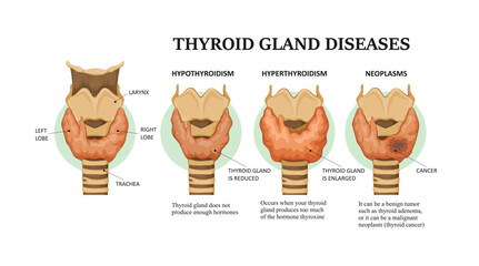 Thyroid gland diseases - hyperthyroidism, hypothyroidism and neoplasms