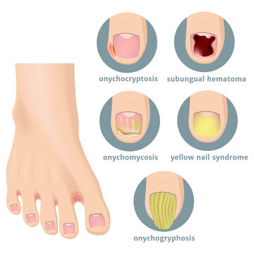 Types of damage to the toenails. Foot with fungus. Medical poster. Vector illustration