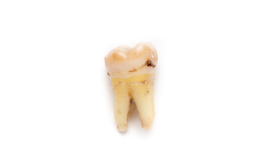 Close-up of a tooth with caries isolated on a white background. Removed wisdom teeth. Sick human teeth.