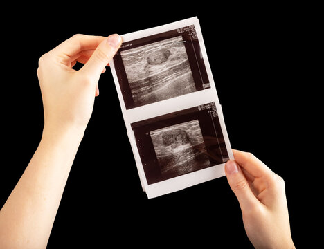 Breast scan in hands. Ultrasound diagnostics of cancer and fibroadenoma