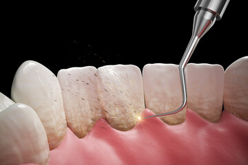 Close up of dental tools while cleaning teeth of patient. 3d illustration of teeth receiving dental treatment.