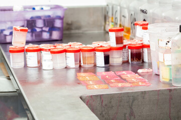 Biopsy samples being processed at the pathology laboratory to be embedded in paraffin for analysis. Cancer diagnosis concept. Medical concept.