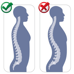 Human anatomy lumbar hyper lordosis illustration. Ideal for catalogues, newsletters and medical guides