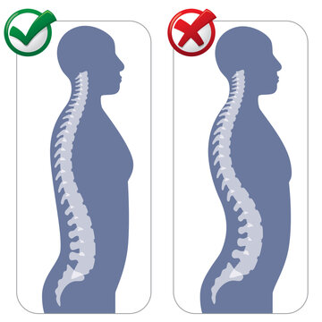 Human anatomy lumbar hyper lordosis illustration. Ideal for catalogues, newsletters and medical guides