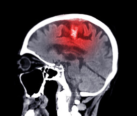 CT scan of the brain
